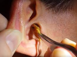 Ear Wax Removal